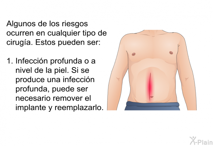 Algunos de los riesgos ocurren en cualquier tipo de ciruga. Estos pueden ser:  Infeccin profunda o a nivel de la piel. Si se produce una infeccin profunda, puede ser necesario remover el implante y reemplazarlo.