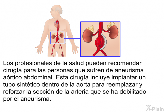 Los profesionales de la salud pueden recomendar ciruga para las personas que sufren de aneurisma artico abdominal. Esta ciruga incluye implantar un tubo sinttico dentro de la aorta para reemplazar y reforzar la seccin de la arteria que se ha debilitado por el aneurisma.