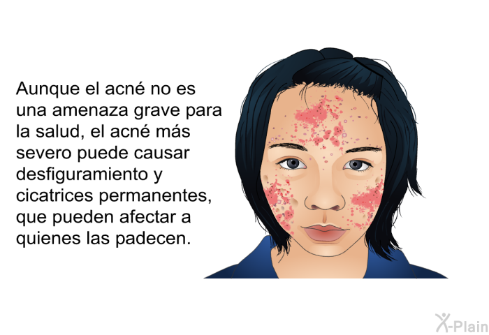 Aunque el acn no es una amenaza grave para la salud, el acn ms severo puede causar desfiguramiento y cicatrices permanentes, que pueden afectar a quienes las padecen.