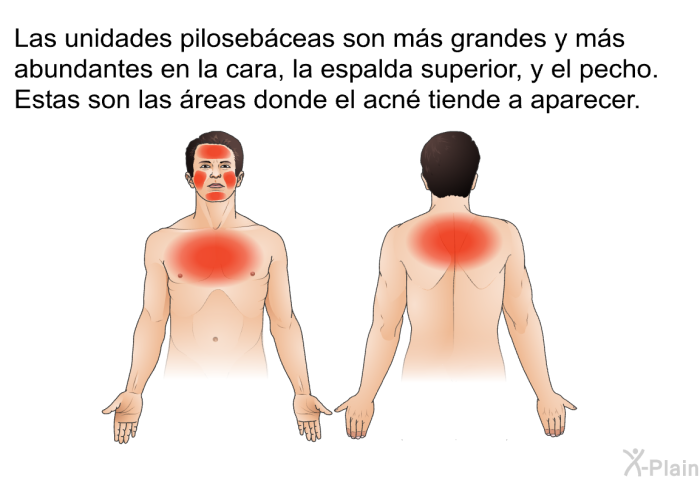 Las unidades pilosebceas son ms grandes y ms abundantes en la cara, la espalda superior, y el pecho. Estas son las reas donde el acn tiende a aparecer.