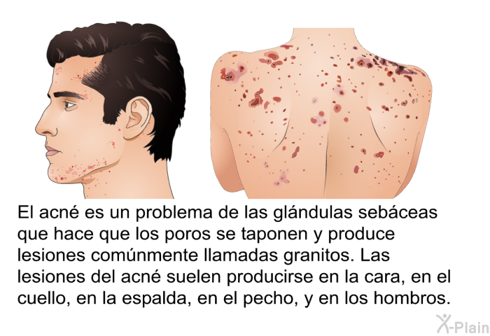 El acn es un problema de las glndulas sebceas que hace que los poros se taponen y produce lesiones comnmente llamadas granitos. Las lesiones del acn suelen producirse en la cara, en el cuello, en la espalda, en el pecho, y en los hombros.