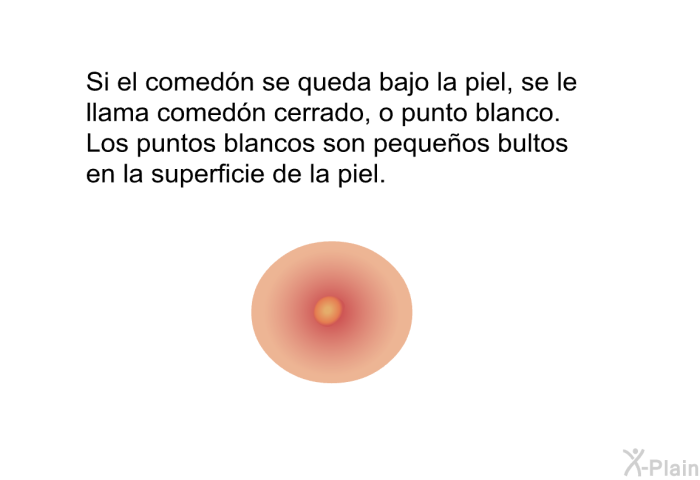 Si el comedn se queda bajo la piel, se le llama comedn cerrado, o punto blanco. Los puntos blancos son pequeos bultos en la superficie de la piel.