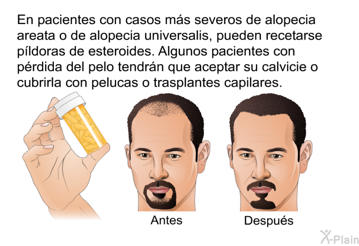 En pacientes con casos m�s severos de alopecia areata o de alopecia universalis, pueden recetarse p�ldoras de esteroides. Algunos pacientes con p�rdida del pelo tendr�n que aceptar su calvicie o cubrirla con pelucas o trasplantes capilares.