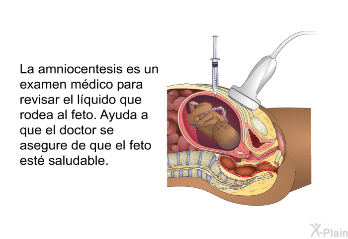 La amniocentesis es un examen mdico para revisar el lquido que rodea al feto. Ayuda a que el doctor se asegure de que el feto est saludable.