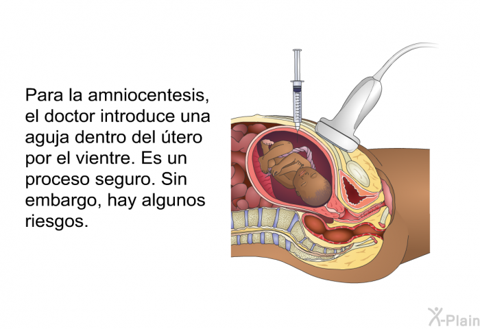 Para la amniocentesis, el doctor introduce una aguja dentro del tero por el vientre. Es un proceso seguro. Sin embargo, hay algunos riesgos.