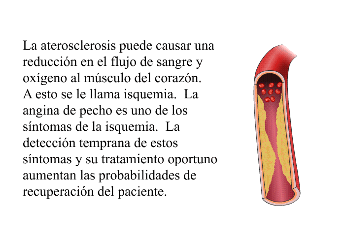 La aterosclerosis puede causar una reduccin en el flujo de sangre y oxgeno al msculo del corazn. A esto se le llama isquemia. La angina de pecho es uno de los sntomas de la <I>isquemia</I>. La deteccin temprana de estos sntomas y su tratamiento oportuno aumentan las probabilidades de recuperacin del paciente.