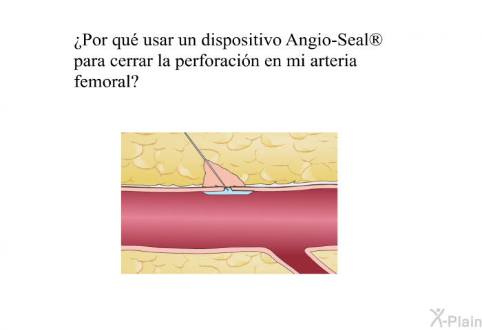 ¿Por qu usar un dispositivo Angio-Seal<SUP> </SUP> para cerrar la perforacin en mi arteria femoral?