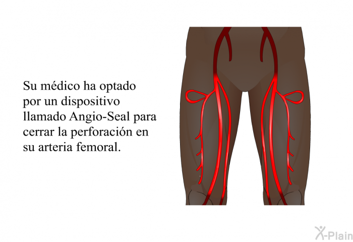 Su mdico ha optado por un dispositivo llamado Angio-Seal para cerrar la perforacin en su arteria femoral.