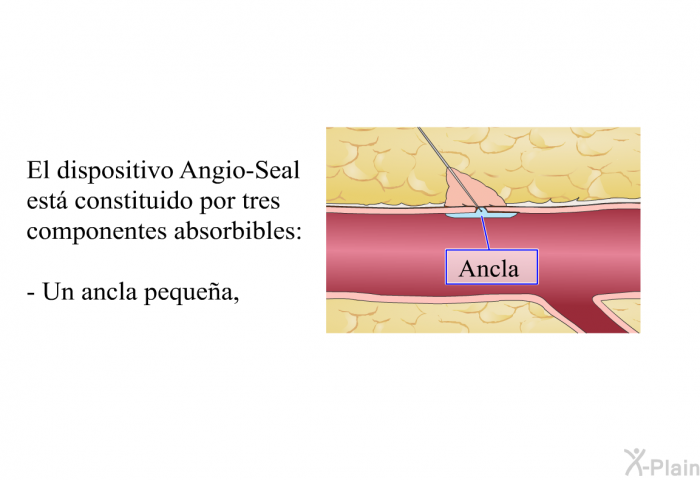 El dispositivo Angio-Seal est constituido por tres componentes absorbibles:  Un ancla pequea,
