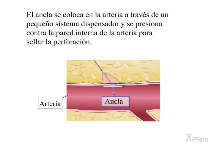 El ancla se coloca en la arteria a travs de un pequeo sistema dispensador y se presiona contra la pared interna de la arteria para sellar la perforacin.
