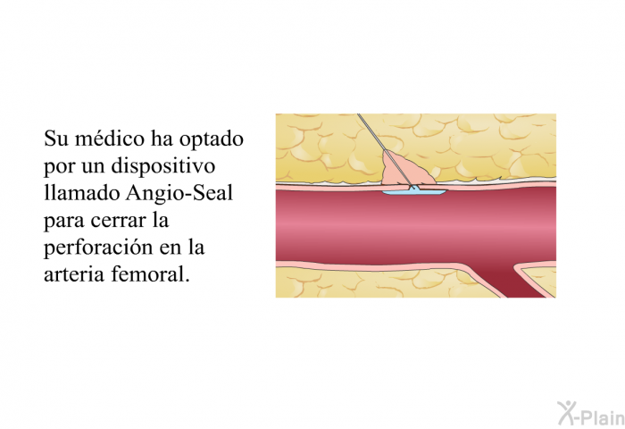 Su mdico ha optado por un dispositivo llamado Angio-Seal para cerrar la perforacin en la arteria femoral.