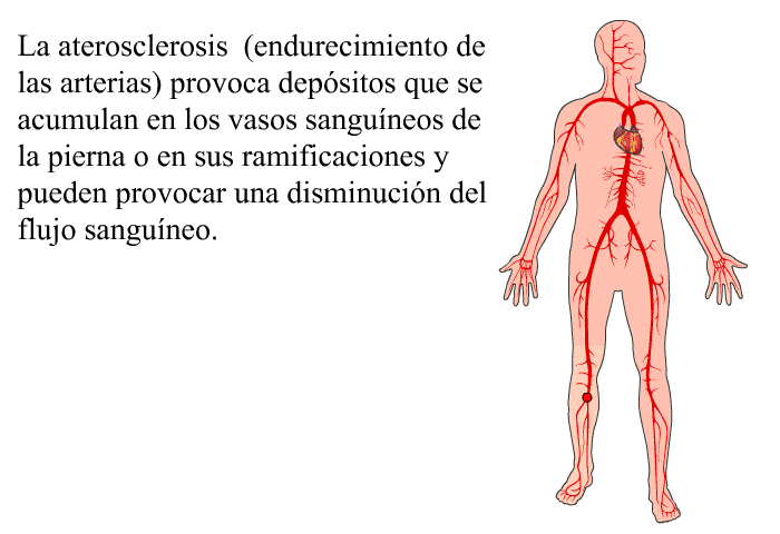 La aterosclerosis (endurecimiento de las arterias) provoca depsitos que se acumulan en los vasos sanguneos de la pierna o en sus ramificaciones y pueden provocar una disminucin del flujo sanguneo.