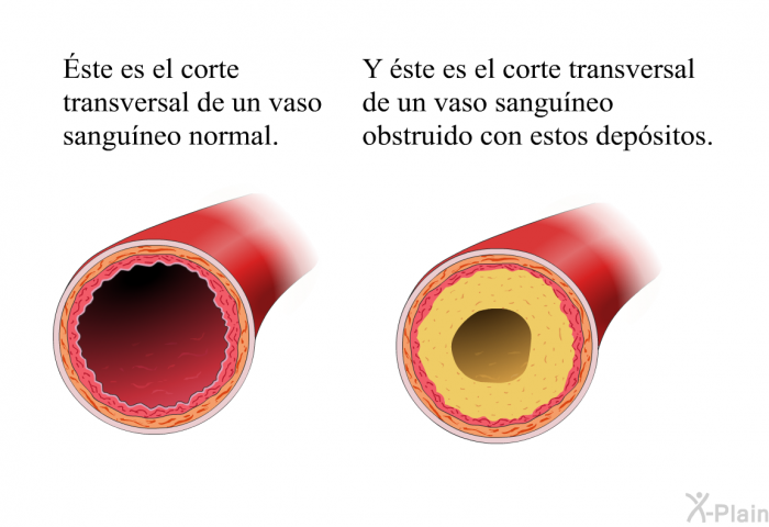 Éste es el corte transversal de un vaso sanguneo normal. Y ste es el corte transversal de un vaso sanguneo obstruido con estos depsitos.