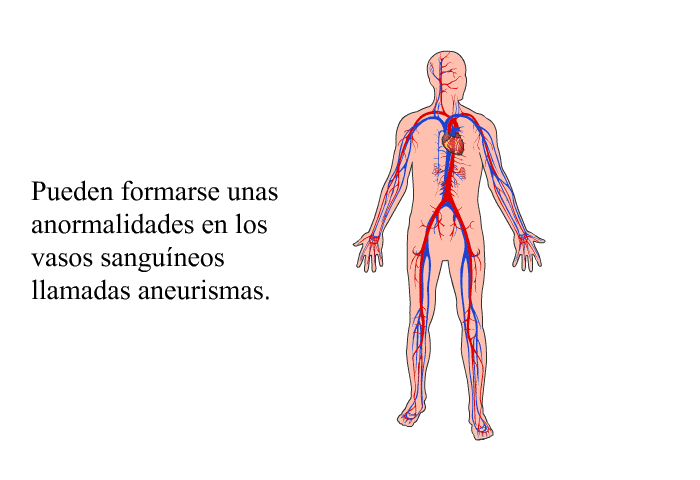 Pueden formarse unas anormalidades en los vasos sanguneos llamadas aneurismas.
