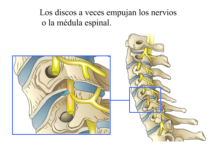 Los discos a veces empujan los nervios o la mdula espinal.