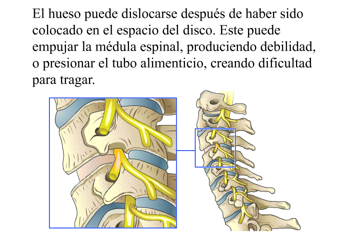 El hueso puede dislocarse despu�s de haber sido colocado en el espacio del disco. Este puede empujar la m�dula espinal, produciendo debilidad, o presionar el tubo alimenticio, creando dificultad para tragar.