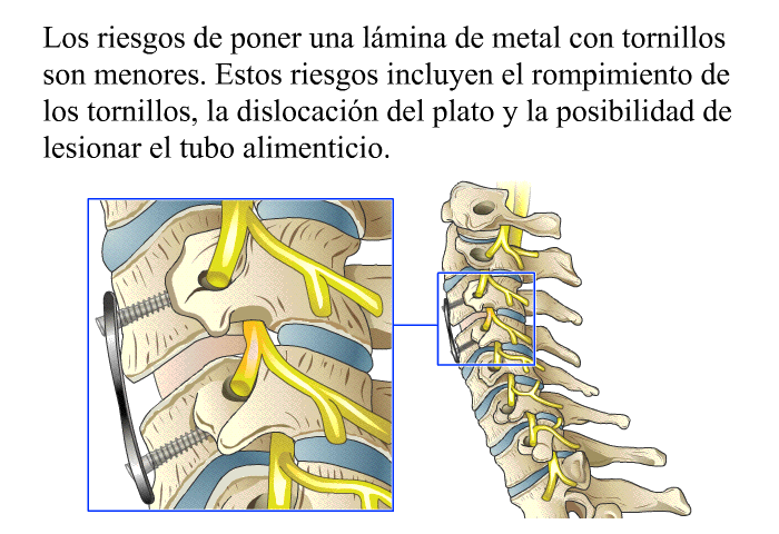 Los riesgos de poner una l�mina de metal con tornillos son menores. Estos riesgos incluyen el rompimiento de los tornillos, la dislocaci�n del plato y la posibilidad de lesionar el tubo alimenticio.