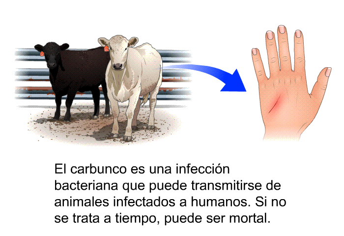 El carbunco es una infeccin bacteriana que puede transmitirse de animales infectados a humanos. Si no se trata a tiempo, puede ser mortal.
