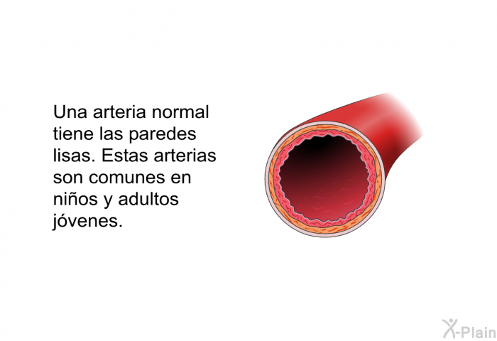 Una arteria normal tiene las paredes lisas. Estas arterias son comunes en nios y adultos jvenes.