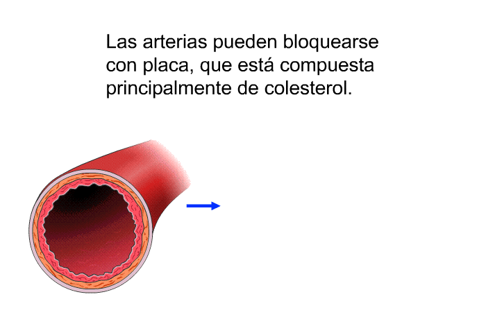 Las arterias pueden bloquearse con placa, que est compuesta principalmente de colesterol.