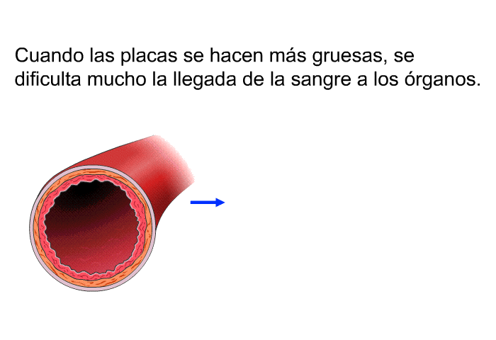 Cuando las placas se hacen ms gruesas, se dificulta mucho la llegada de la sangre a los rganos.