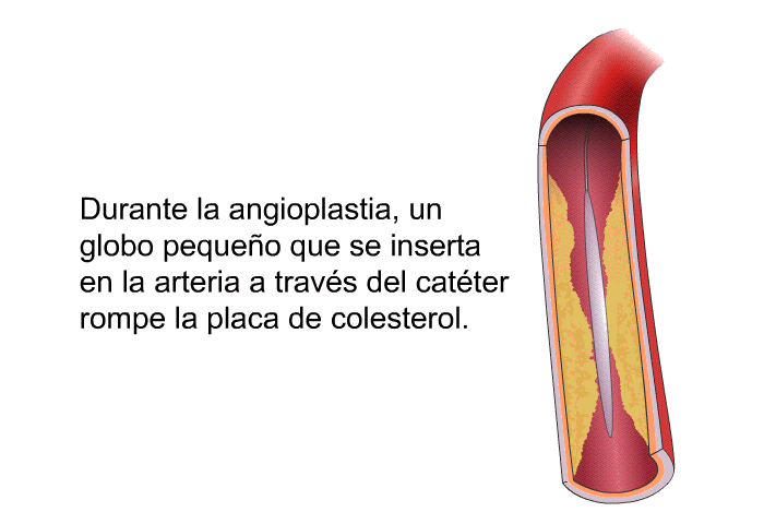 Durante la angioplastia, un globo pequeo que se inserta en la arteria a travs del catter rompe la placa de colesterol.