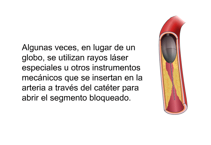 Algunas veces, en lugar de un globo, se utilizan rayos lser especiales u otros instrumentos mecnicos que se insertan en la arteria a travs del catter para abrir el segmento bloqueado.