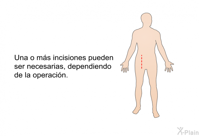 Una o ms incisiones pueden ser necesarias, dependiendo de la operacin.