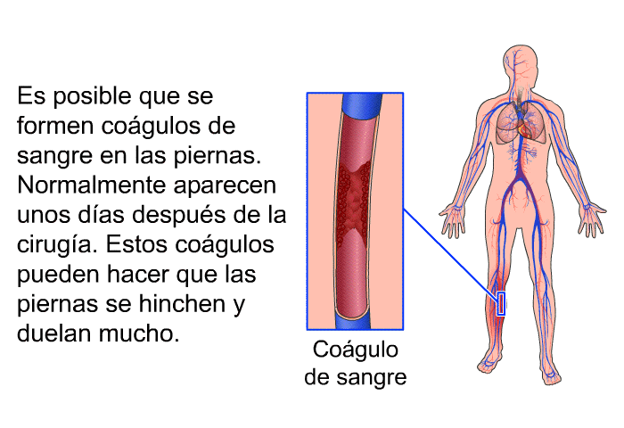 Es posible que se formen cogulos de sangre en las piernas. Normalmente aparecen unos das despus de la ciruga. Estos cogulos pueden hacer que las piernas se hinchen y duelan mucho.