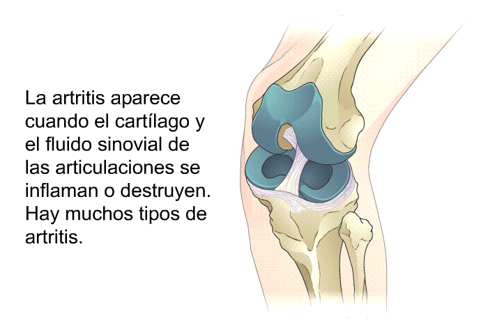 La artritis aparece cuando el cartlago y el fluido sinovial de las articulaciones se inflaman o destruyen. Hay muchos tipos de artritis.