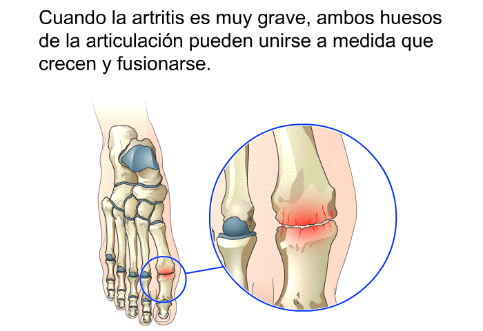Cuando la artritis es muy grave, ambos huesos de la articulaci�n pueden unirse a medida que crecen y fusionarse.