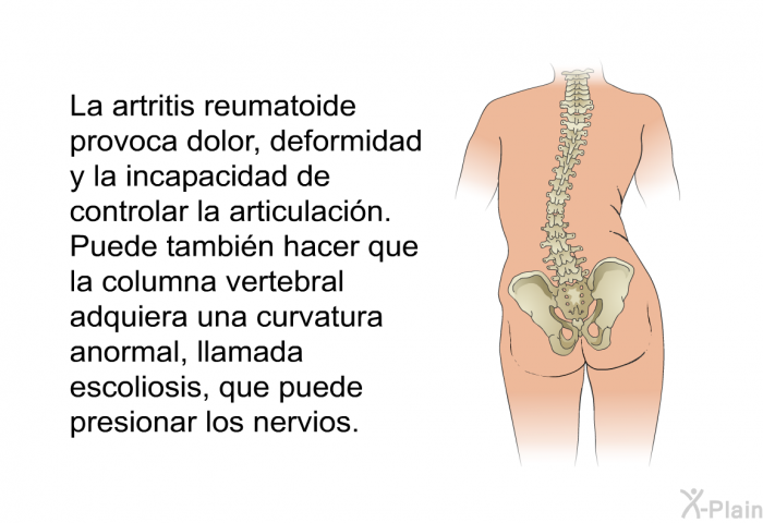 La artritis reumatoide provoca dolor, deformidad y la incapacidad de controlar la articulaci�n. Puede tambi�n hacer que la columna vertebral adquiera una curvatura anormal, llamada escoliosis, que puede presionar los nervios.