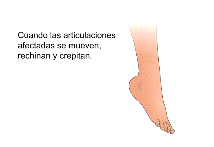 Cuando las articulaciones afectadas se mueven, rechinan y crepitan.