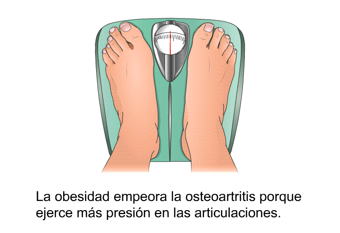 La obesidad empeora la osteoartritis porque ejerce m�s presi�n en las articulaciones.