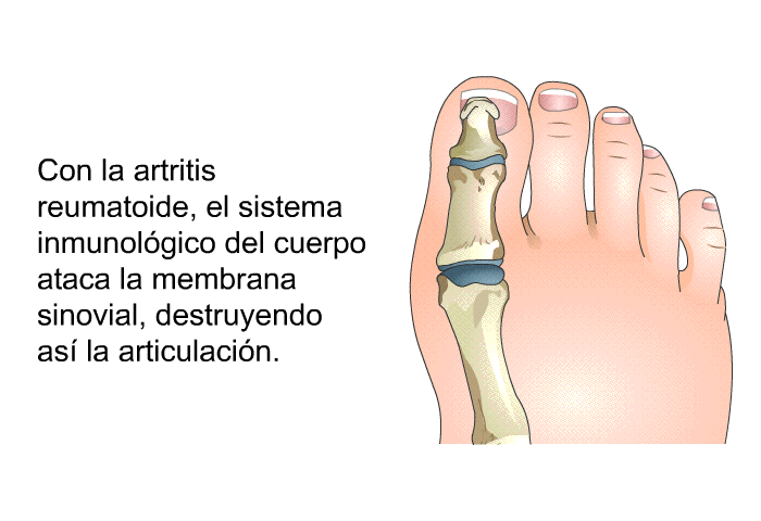 Con la artritis reumatoide, el sistema inmunol�gico del cuerpo ataca la membrana sinovial, destruyendo as� la articulaci�n.