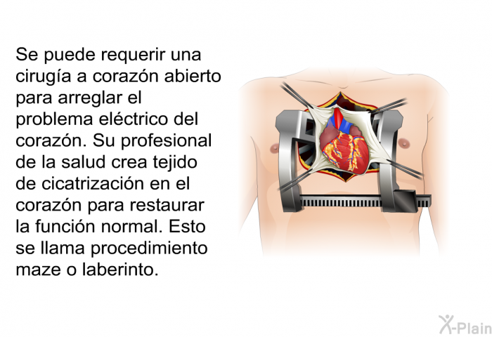 Se puede requerir una ciruga a corazn abierto para arreglar el problema elctrico del corazn. Su profesional de la salud crea tejido de cicatrizacin en el corazn para restaurar la funcin normal. Esto se llama procedimiento maze o laberinto.