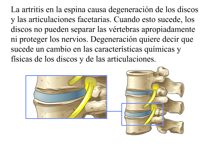 La artritis en la espina causa degeneracin de los discos y las articulaciones facetarias. Cuando esto sucede, los discos no pueden separar las vrtebras apropiadamente ni proteger los nervios. Degeneracin quiere decir que sucede un cambio en las caractersticas qumicas y fsicas de los discos y de las articulaciones.