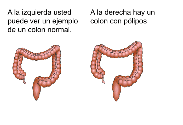 A la izquierda usted puede ver un ejemplo de un colon normal. A la derecha hay un colon con plipos.