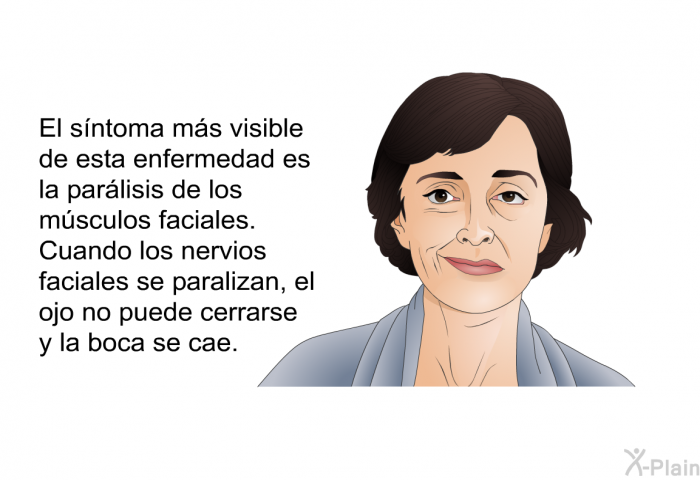 El sntoma ms visible de esta enfermedad es la parlisis de los msculos faciales. Cuando los nervios faciales se paralizan, el ojo no puede cerrarse y la boca se cae.