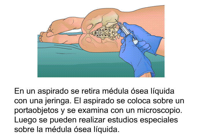 En un aspirado se retira mdula sea lquida con una jeringa. El aspirado se coloca sobre un portaobjetos y se examina con un microscopio. Luego se pueden realizar estudios especiales sobre la mdula sea lquida.