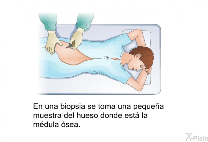 En una biopsia se toma una pequea muestra del hueso donde est la mdula sea.
