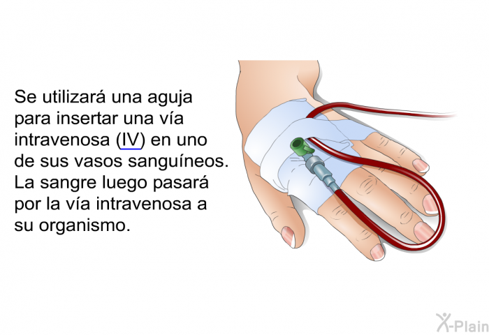 Se utilizar� una aguja para insertar una v�a intravenosa (IV) en uno de sus vasos sangu�neos.&nbsp;La sangre luego pasar� por la v�a intravenosa a su organismo.