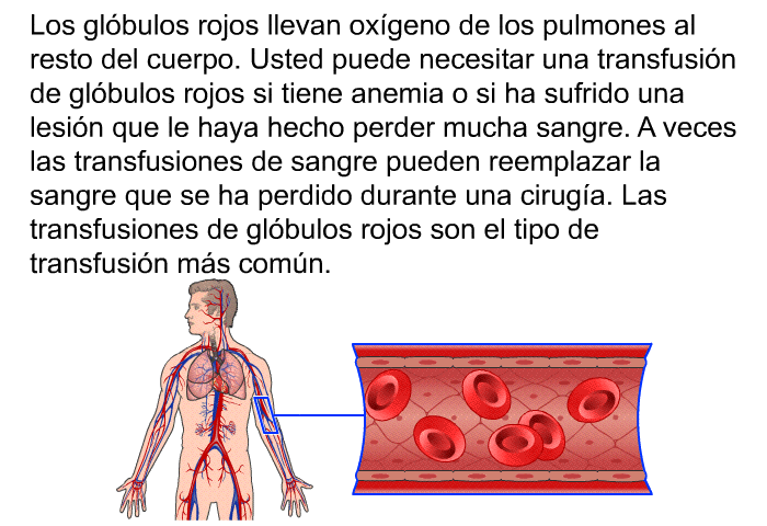 Los glbulos rojos llevan oxgeno de los pulmones al resto del cuerpo. Usted puede necesitar una transfusin de glbulos rojos si tiene anemia o si ha sufrido una lesin que le haya hecho perder mucha sangre. A veces las transfusiones de sangre pueden reemplazar la sangre que se ha perdido durante una ciruga. Las transfusiones de glbulos rojos son el tipo de transfusin ms comn.