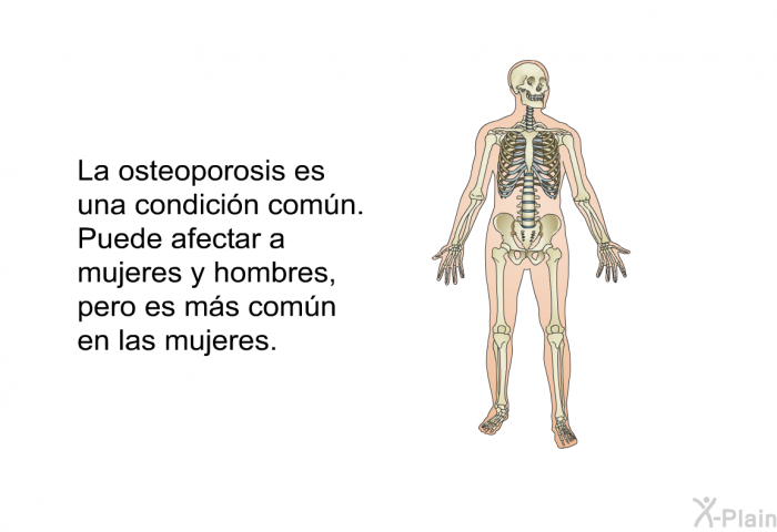 La osteoporosis es una condición común. Puede afectar a mujeres y hombres, pero es más común en las mujeres.