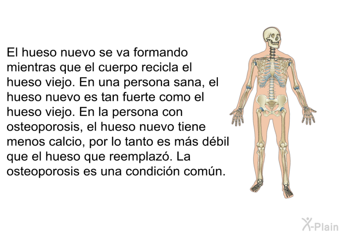 El hueso nuevo se va formando mientras que el cuerpo recicla el hueso viejo. En una persona sana, el hueso nuevo es tan fuerte como el hueso viejo. En la persona con osteoporosis, el hueso nuevo tiene menos calcio, por lo tanto es m�s d�bil que el hueso que reemplaz�. La osteoporosis es una condici�n com�n.