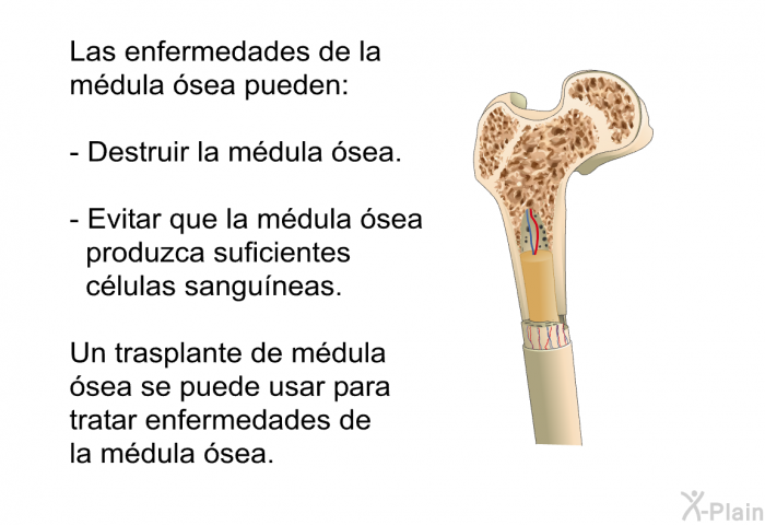 Las enfermedades de la mdula sea pueden:  Destruir la mdula sea. Evitar que la mdula sea produzca suficientes clulas sanguneas.  
 Un trasplante de mdula sea se puede usar para tratar enfermedades de la mdula sea.