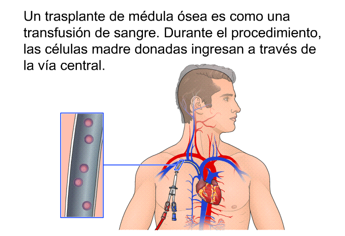 Un trasplante de mdula sea es como una transfusin de sangre. Durante el procedimiento, las clulas madre donadas ingresan a travs de la va central.