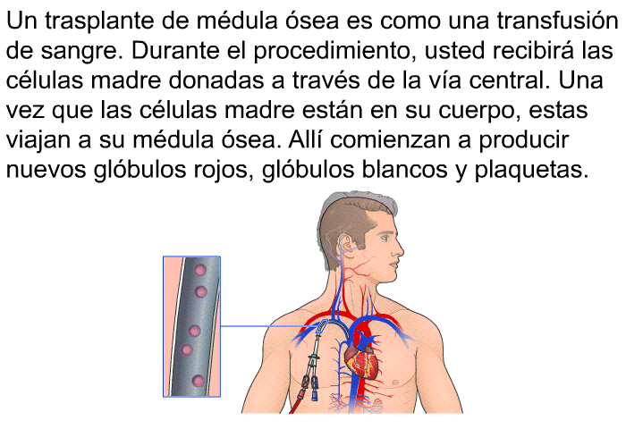 Un trasplante de mdula sea es como una transfusin de sangre. Durante el procedimiento, usted recibir las clulas madre donadas a travs de la va central. Una vez que las clulas madre estn en su cuerpo, estas viajan a su mdula sea. All comienzan a producir nuevos glbulos rojos, glbulos blancos y plaquetas.
