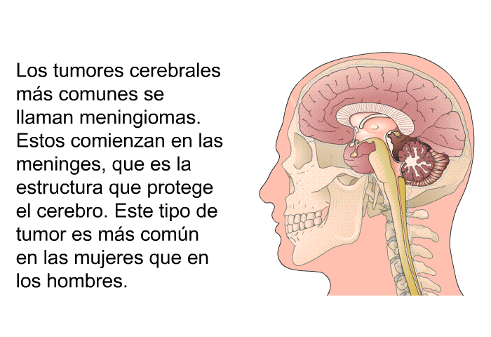 Los tumores cerebrales ms comunes se llaman <I>meningiomas</I>. Estos comienzan en las meninges, que es la estructura que protege el cerebro. Este tipo de tumor es ms comn en las mujeres que en los hombres.