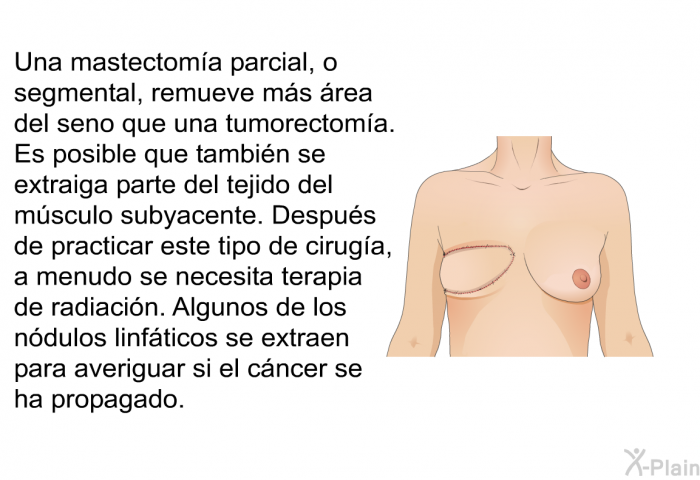 Una mastectoma parcial, o segmental, remueve ms rea del seno que una tumorectoma. Es posible que tambin se extraiga parte del tejido del msculo subyacente. Despus de practicar este tipo de ciruga, a menudo se necesita terapia de radiacin. Algunos de los ndulos linfticos se extraen para averiguar si el cncer se ha propagado.